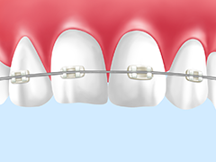 プチ矯正治療に最適な『ワイヤー矯正』　