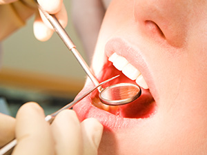 コンポジットレジンを使って短期間で歯を修復いたします