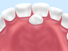 過剰歯（かじょうし）の抜歯