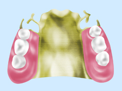 金属床義歯（ゴールド床、チタン床、コバルトクロム床）