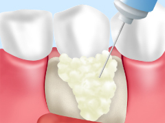 エムドゲイン法（歯周組織再生療法）